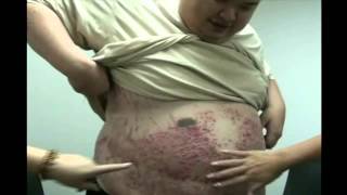 乾癬牛皮癬(銀屑病 Psoriasis)自然痊癒的親身見證