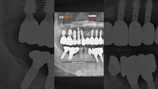 How to manage socket defects at premolar immediate implant cases