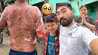 | A young boy's arms got STUCK to his body due to the burns he suffered when he was a child 🥺|