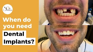 Dental Implants in Staten Island | Sola Dental Spa