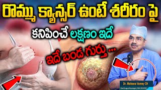 రొమ్ము కాన్సర్ లక్షణాలు || Breast Cancer || Dr.Mohan Vamsi About Cancer || Sumantv Health