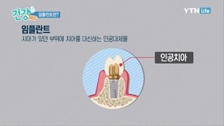 임플란트란? / YTN 라이프