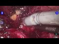 laparoscopic and robotic radical prostatectomy part vi surgical procedure