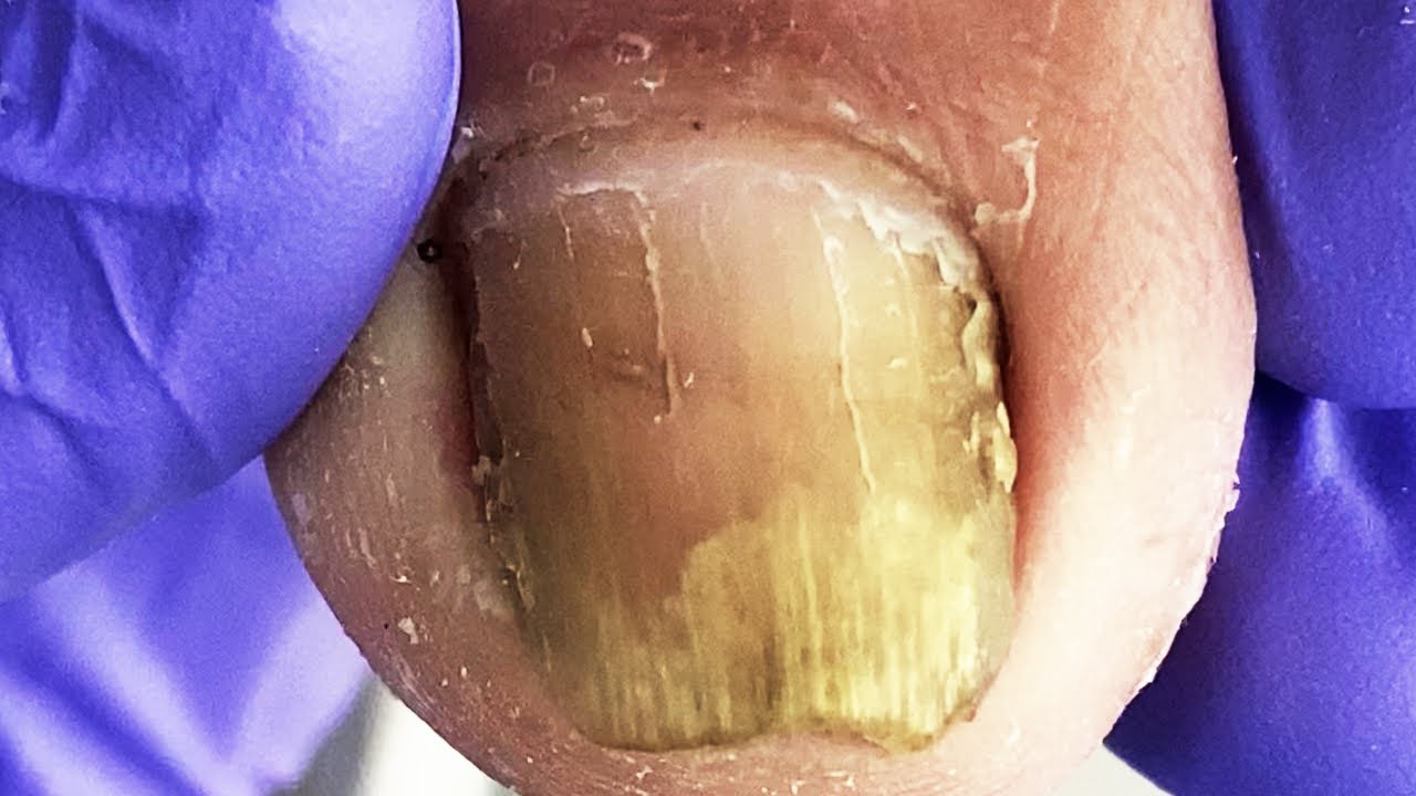 Germs Under Nails Microscope At Laura Painter Blog
