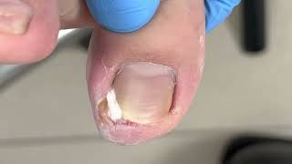 Solve the problem of ingrown nails and heal quickly【Xue Yidao】