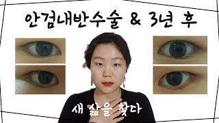 안검내반 수술 후기 (3+년) ｜KKangster