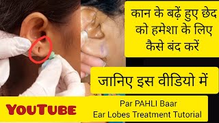 Ear lobe repair kaise kare👂👂 | ear pasting Treatment | कान के बढ़े हुए छेद बंद करें | #earloberepair
