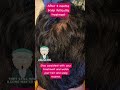 Scalp follicultis | hairloss treatment | Consistency | Dr Ashima Goel MD Dermatologist | PARISA skin