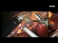 prof. pier c. giulianotti robotic hpb surgery