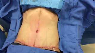 Tummy Tuck / Abdominoplasty - Before and After -  Dr  Anthony Youn