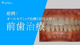 他院で治療した前歯を治したい　|　前歯のオールセラミック治療例　30代女性【症例】