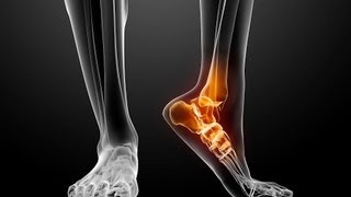 Plantar Fasciitis Heel Pain Exercises Pakvim Net Hd Vdieos Portal