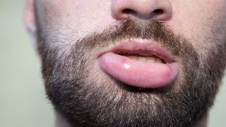 How To Get Rid Of A Swollen Lip From Biting