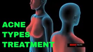 ACNE | The Understanding Types and Too Treatment Options