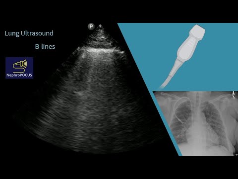 B Lines On Lung Ultrasound Before And After Dialysis: A POCUS Case ...