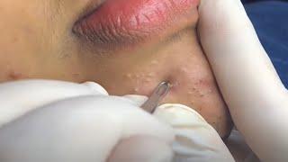 #2 |Acne Treatment By Beauty Angel | Part2 - On the chin