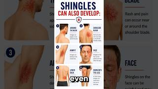 Most People Don’t Realize Shingles Can Show Up Here