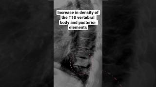 Blastic metastatic cancer to the spine causing an ivory vertebra #xray #radiology #medical