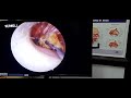 endoscopic removal of impacted cotton from ear foreign body ear cotton in ear ear care earbuds