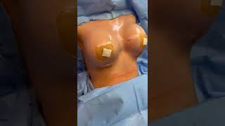 Breast Augmentation Before and After