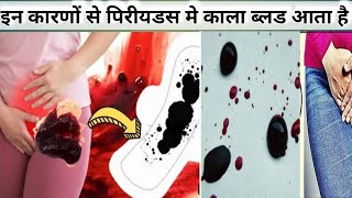 पिरीयडस मे काला ब्लड आने का कारण।। Black Bleeding in Periods in Hindi।Black Blood in Early Pregnancy