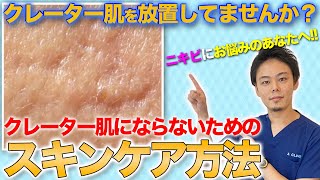 ニキビに悩んでる人は見て！クレーター肌にならないためのスキンケアを医師が解説！