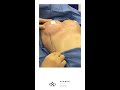 reno breast fat transfer fat grafting breast augmentation lake tahoe plastic surgery institute