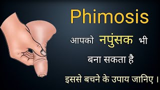 Phimosis - Causes \u0026 Treatment | Paraphimosis Treatment Without Surgery | Dr. Imran Khan in HINDI