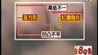 雅丰麗緻診所整形外科林孟羲醫師 雙面複合式隆乳東森新聞.WMV