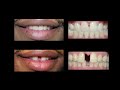 invisaign for teeth gap treatment at cosmetic dental associates