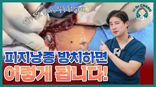 피지낭종, 방치하면 이렇게 됩니다!