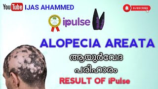 #iPulse Malayalam Result | Alopecia areata | IndusViva | Ijas Ahammed |