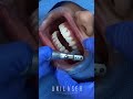 Shiny smiles with Unilaser- Bonding veneers