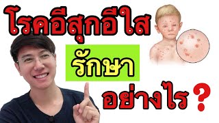 โรคอีสุกอีใสรักษาและป้องกันอย่างไร