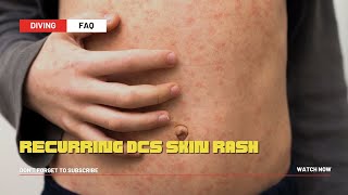Recurring Skin Rash After Diving