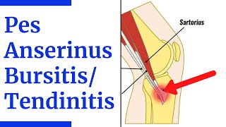 Pes Anserine Bursitis/Tendinitis Evaluation