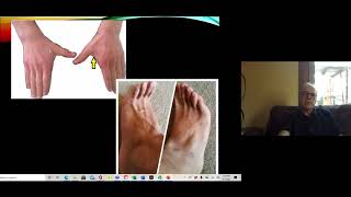 Peripheral Neuropathy and Mononeuropathy