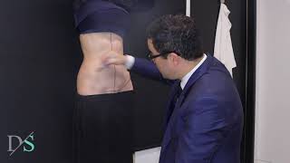 Abdominoplasty incision placement with Dr David Sharp