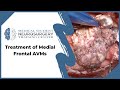 Treatment of Medial Frontal AVMs