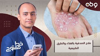 10 أعشاب طبيعية تحد من انتشار الصدفية