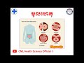 រោគសញ្ញា ជំងឺស្ទះពោះវៀន symptoms of intestinal obstruction l cml health science official