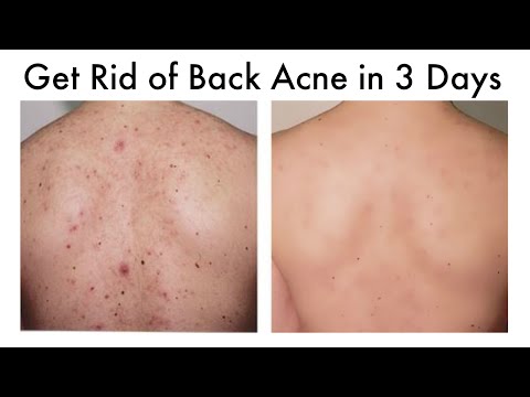 How to Get Rid of Back Acne At Home in 3 Days How to Get Rid of Back Acne At Home in 3 Days