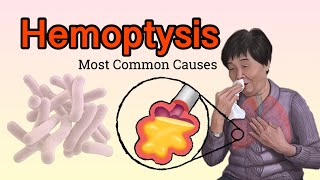 Hemoptysis (Types-Causes-History-Dx-Management )