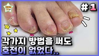 eng[1]직접 발톱을 갈고 뽑아 봤지만 아무런 효과가 없었어요｜레푸스 서면점/사상점/남포점｜문제성발톱｜ingrown toenail｜Athlete's foot-Fresh Foot