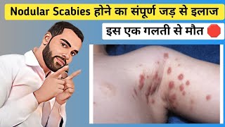 Nodular scabies होने का जड़ से संपूर्ण इलाज 💯