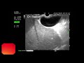 linear endoscopic ultrasound examination from d1 station