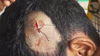 মানুষের কাটা মাথা কিভাবে সেলাই করে?  How to sew the severed head of a person?