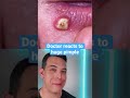 HUGE Painful Pimple on the￼ lip! | 208SkinDoc