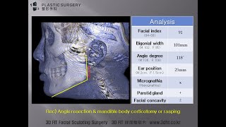 [사각턱수술전 고려사항] 사각턱수술을 했는데 얼굴이 작아지질 않았어요...