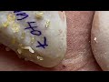 blackheads extraction 407 loan nguyen